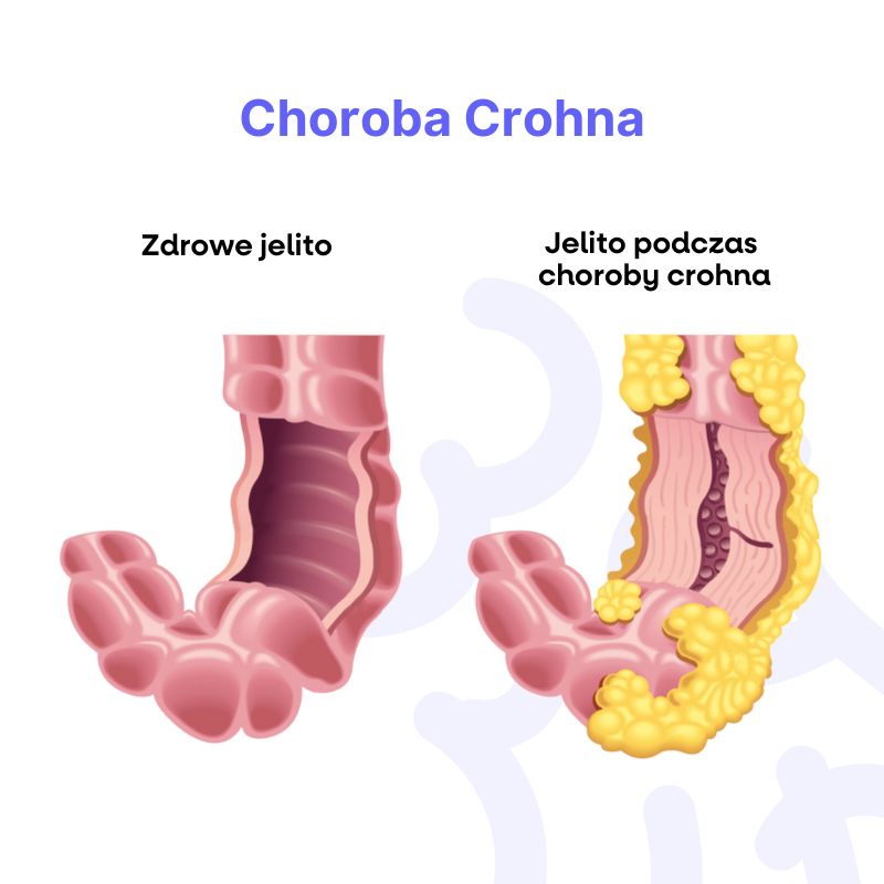 Crohnova choroba